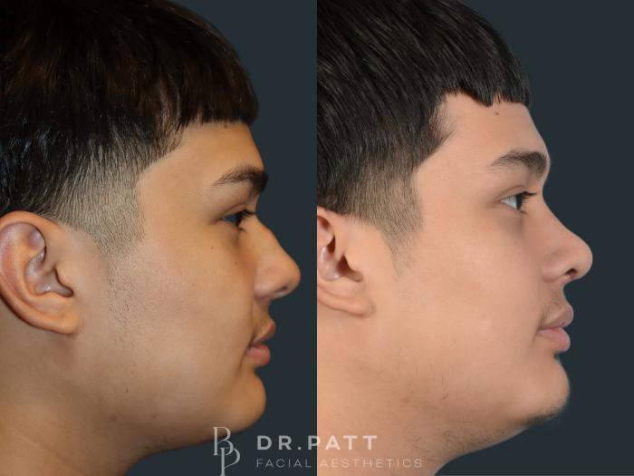 Before & After Rhinoplasty (Nose Job) Case 6 Right Side View in Houston, TX