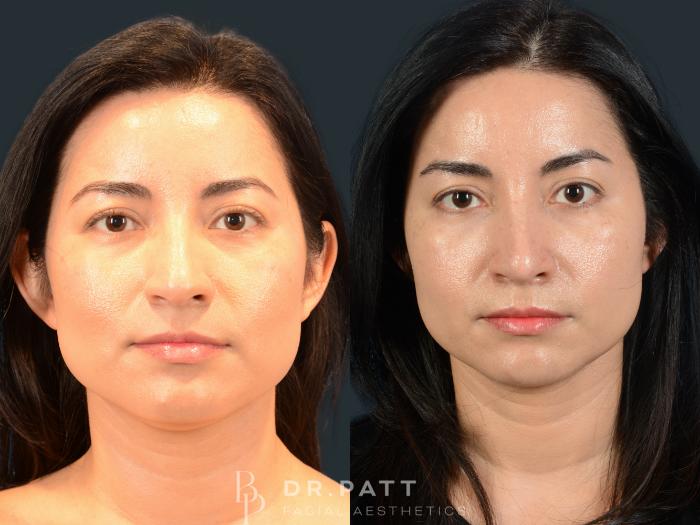 Before & After Rhinoplasty (Nose Job) Case 7 Front 1 View in Houston, TX