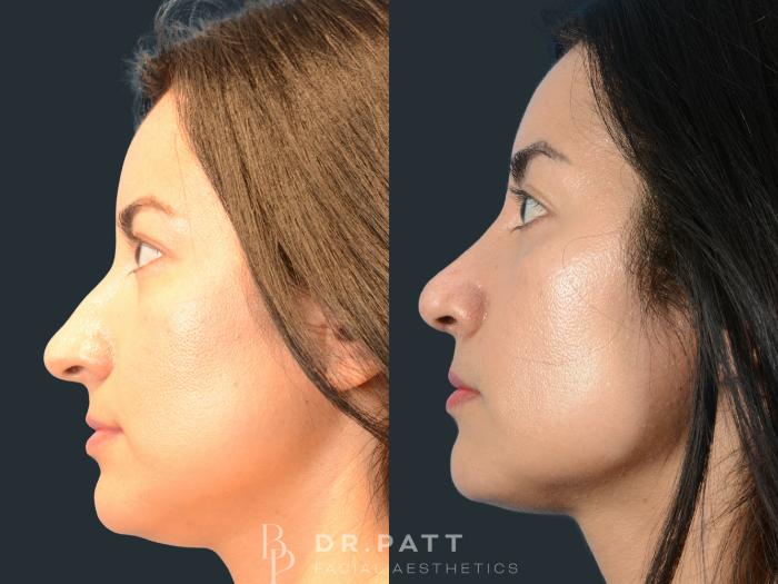 Before & After Rhinoplasty (Nose Job) Case 7 Left Side View in Houston, TX