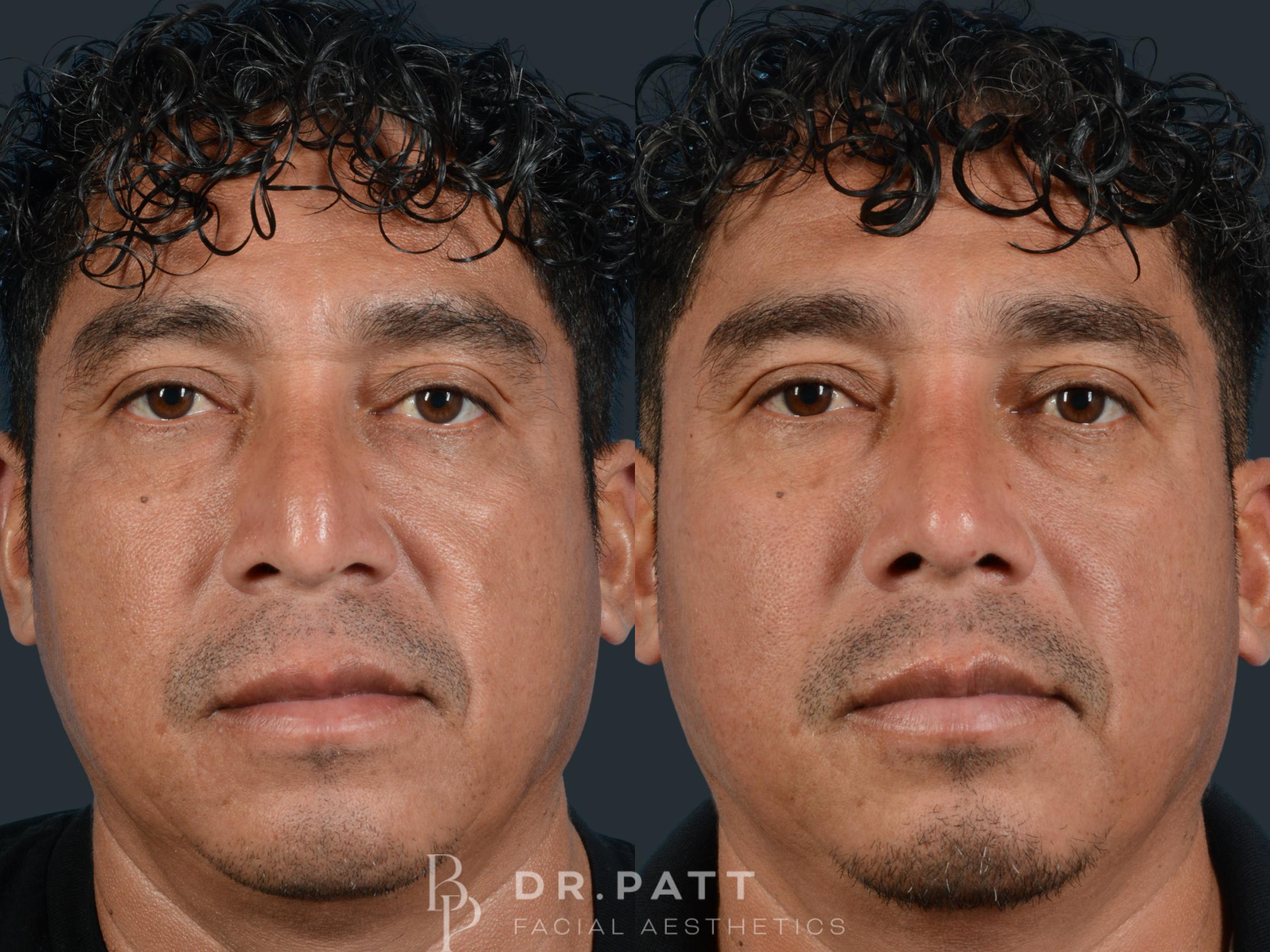 Before & After Rhinoplasty (Nose Job) Case 8 Front 1 View in Houston, TX