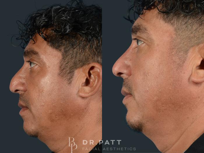Before & After Rhinoplasty (Nose Job) Case 8 Left Side View in Houston, TX