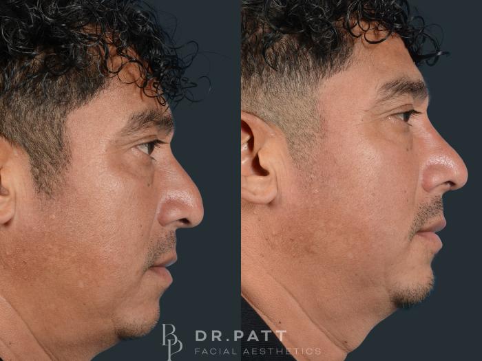 Before & After Rhinoplasty (Nose Job) Case 8 Right Side View in Houston, TX